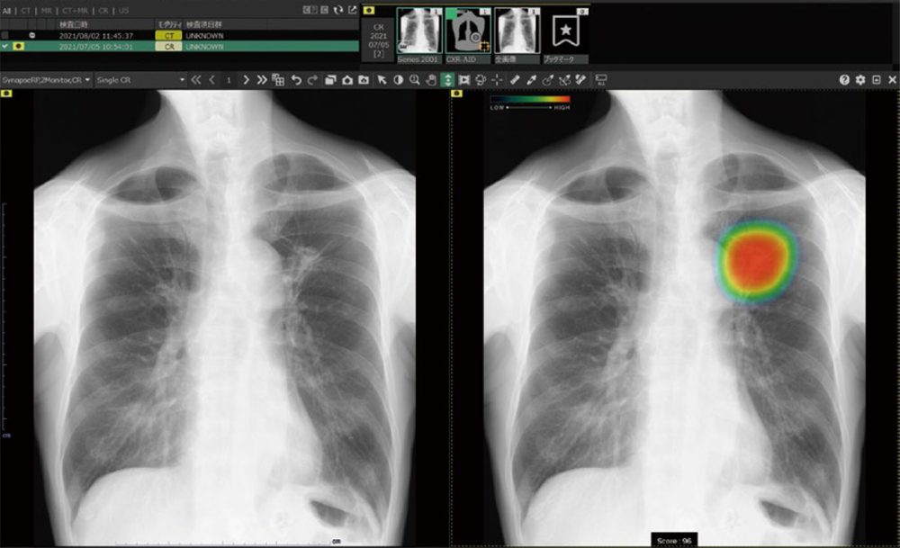 CXR-AIDの機能