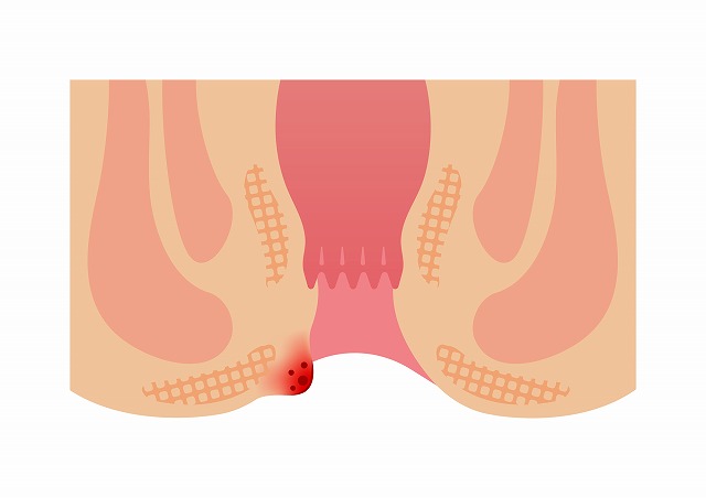 外痔核（外側のいぼ痔）